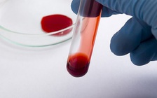 Phát hiện 13 loại ung thư với độ chính xác 99% chỉ với 1 giọt máu