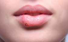 Làm sao để tránh nứt môi vào mùa lạnh?