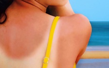 Vết sẹo thủy đậu lúc bé ai ngờ phát triển thành ung thư da