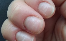 Hay cắn móng tay, cô gái suýt bị cắt cụt đầu ngón tay