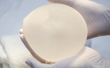 Sau phẫu thuật nâng mông, cô gái không thể ngồi suốt 6 tháng