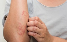 5 dấu hiệu kèm theo mẩn đỏ không được chủ quan