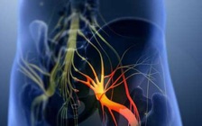 5 dấu hiệu để nhận biết cơn đau thần kinh tọa