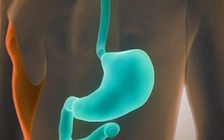 Bố mẹ đi vắng, cậu bé nuốt... 123 viên nam châm vào bụng