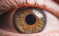 Bé gái bị mù 1 mắt do dùng điện thoại thông minh quá nhiều