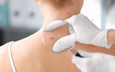 Cô gái sống như 'ma cà rồng' do bị ung thư da đến... 28 lần