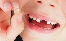 Bị gãy răng, bác sĩ phát hiện cậu bé 5 tuổi bị ung thư hiếm gặp