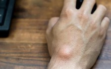 Điều gì sẽ xảy ra nếu các khối u nang không được điều trị?