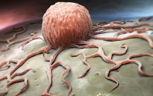 Căn bệnh lạ khiến cô gái có hàng trăm khối u khắp cơ thể