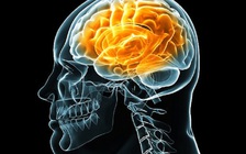 Covid-19 có thể gây viêm và chảy máu não