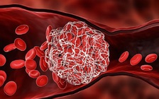 Người khỏi Covid-19 dễ bị cục máu đông trong 6 tháng