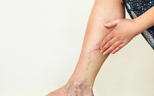 Làm sao để biết đau chân là do suy giãn tĩnh mạch?