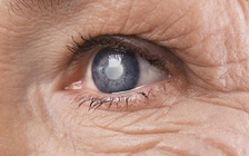 Thử nghiệm loại thuốc điều trị đục thủy tinh thể mà không cần phẫu thuật