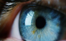 Phát hiện ca nhiễm loại sốt xuất huyết gây chảy máu mắt