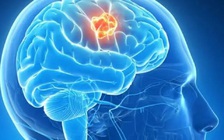 Bị đau răng, bất ngờ phát hiện đó là triệu chứng của u não