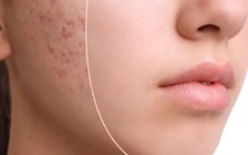 Bị mụn trứng cá do nội tiết, nên tránh ăn thực phẩm nào?