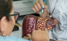 Cơ thể sẽ thay đổi thế nào khi bị viêm gan C?