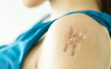 Làm thế nào để trị sẹo lồi tốt nhất?