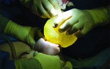 Mất ngực do tiêm silicon dạo