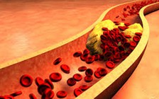 Cholesterol cao, coi chừng mắc bệnh tim và viêm xương khớp