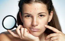 Những vị trí nổi mụn cảnh báo sức khỏe