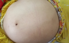 Bệnh nhân mang 2 khối u to trong bụng