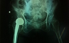 Thay khớp háng miễn phí cho Bà mẹ Việt Nam anh hùng