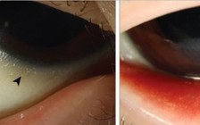 Ăn kiêng khắc nghiệt khiến cậu bé Canada gần như bị mù