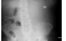 Bật lửa chảy nhiên liệu trong ruột bệnh nhân, gây loét dạ dày