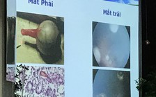 Dấu hiệu nào để nhận biết con trẻ bị ung thư mắt?