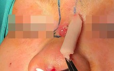 Sau nâng mũi tại spa, cây sụn silicon lòi ra trên mặt