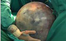 Cắt bỏ khối u 34 kg trong người một phụ nữ