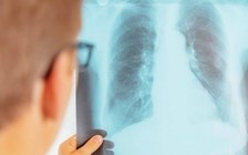 Tổ chức Y tế Thế giới thúc giục Âu, Á tăng cường chống lao