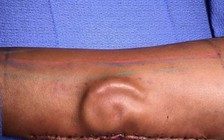 Nuôi cấy tai trong cánh tay của bệnh nhân