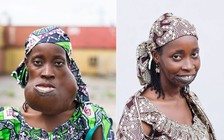 Người phụ nữ nở nụ cười sau 8 năm mang trên mặt khối u 'khủng'