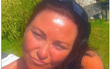 Người phụ nữ bị ung thư da nhưng vẫn nghiện phơi nắng