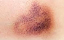 Vì sao xuất hiện vết bầm tím trên da, có nguy hiểm?