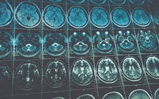 Dùng vi rút bại liệt để điều trị ung thư não