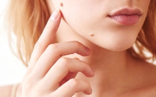 4 dấu hiệu cảnh báo những thay đổi ở nốt ruồi có thể là ung thư