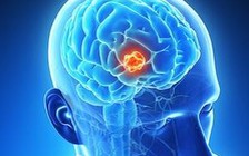 Thấy dấu hiệu này ở mắt, hãy mau đi khám u não