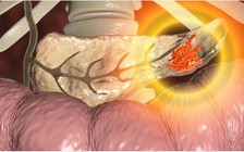 Đau lưng kiểu này, mau đi khám ung thư tụy ngay!