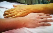 Gặp những dấu hiệu này, đi khám gan mau