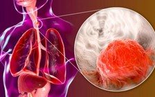 Một triệu chứng chưa từng được biết đến của ung thư thực quản