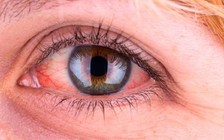 5 nguyên nhân phổ biến khiến bạn bị mắt đỏ