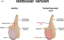 Thời tiết lạnh có thể gây xoắn tinh hoàn nguy hiểm