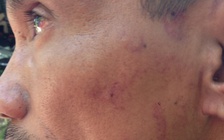 Đang làm rõ vụ người tâm thần sưng vù mặt khi ra khỏi đồn công an