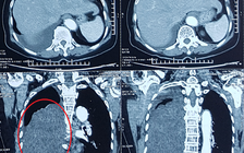 Cứu cụ bà bị khối u lớn chèn ép tim, phổi