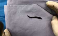 Gắp con đỉa còn sống ra khỏi cổ họng cháu bé