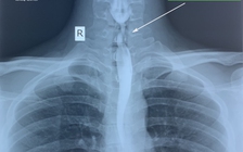 Cứu bệnh nhân suýt tắc thực quản do uống nước tẩy rửa bồn cầu