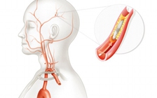 Báo động nguy cơ đột quỵ gia tăng ở người trẻ tuổi